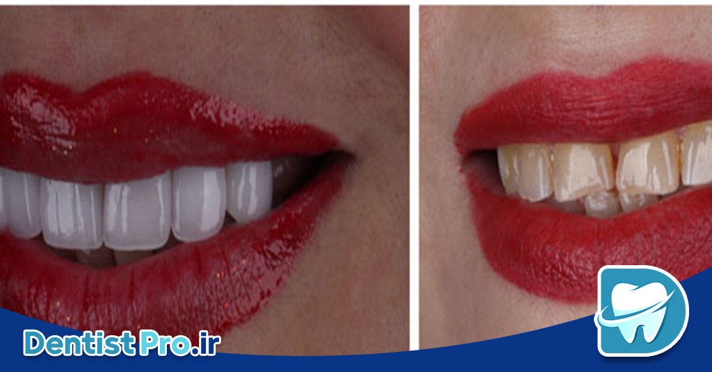 بهترین نوع لمینت برای دندان جلو از نگاه یک دندانپزشک متخصص