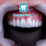 بهترین نوع لمینت برای دندان جلو از نگاه یک دندانپزشک متخصص