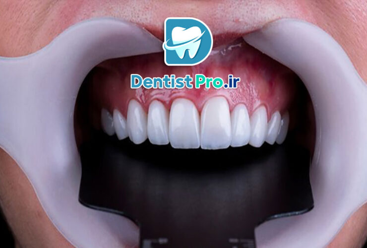 بهترین نوع لمینت برای دندان جلو از نگاه یک دندانپزشک متخصص 27 بهترین نوع لمینت برای دندان جلو از نگاه یک دندانپزشک متخصص