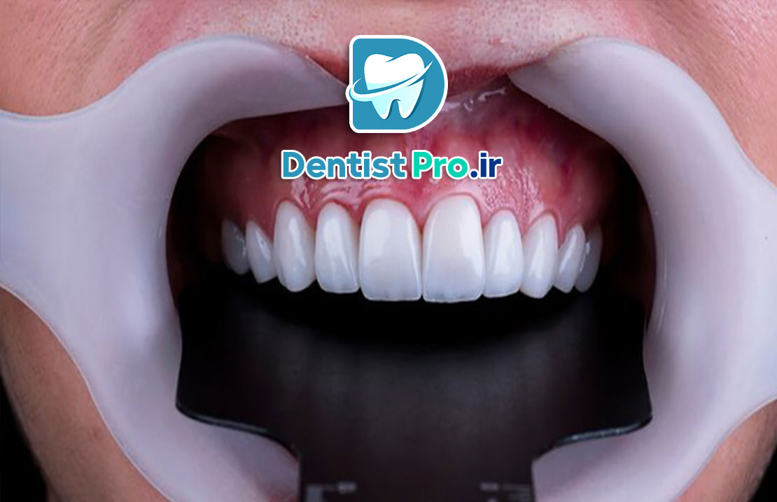 بهترین نوع لمینت برای دندان جلو از نگاه یک دندانپزشک متخصص