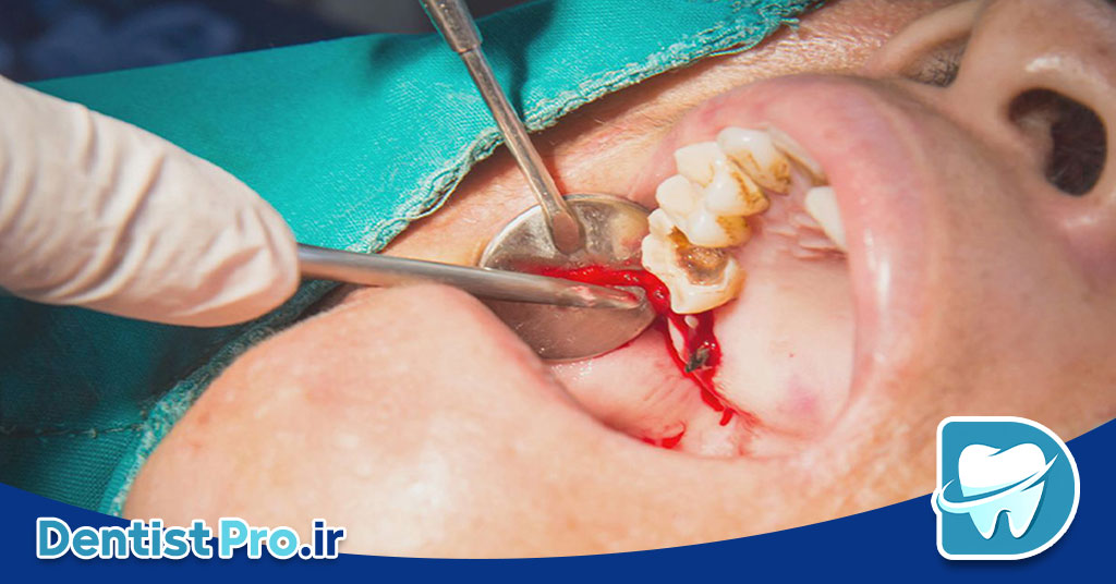 خطرناک بودن دندان عفونی: تهدیدی پنهان برای سلامت شما از نگاه یک دندانپزشک متخصص