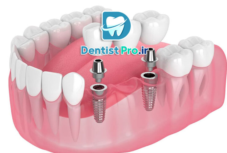 تفاوت ایمپلنت و بریج+بررسی 3 بعد مهم