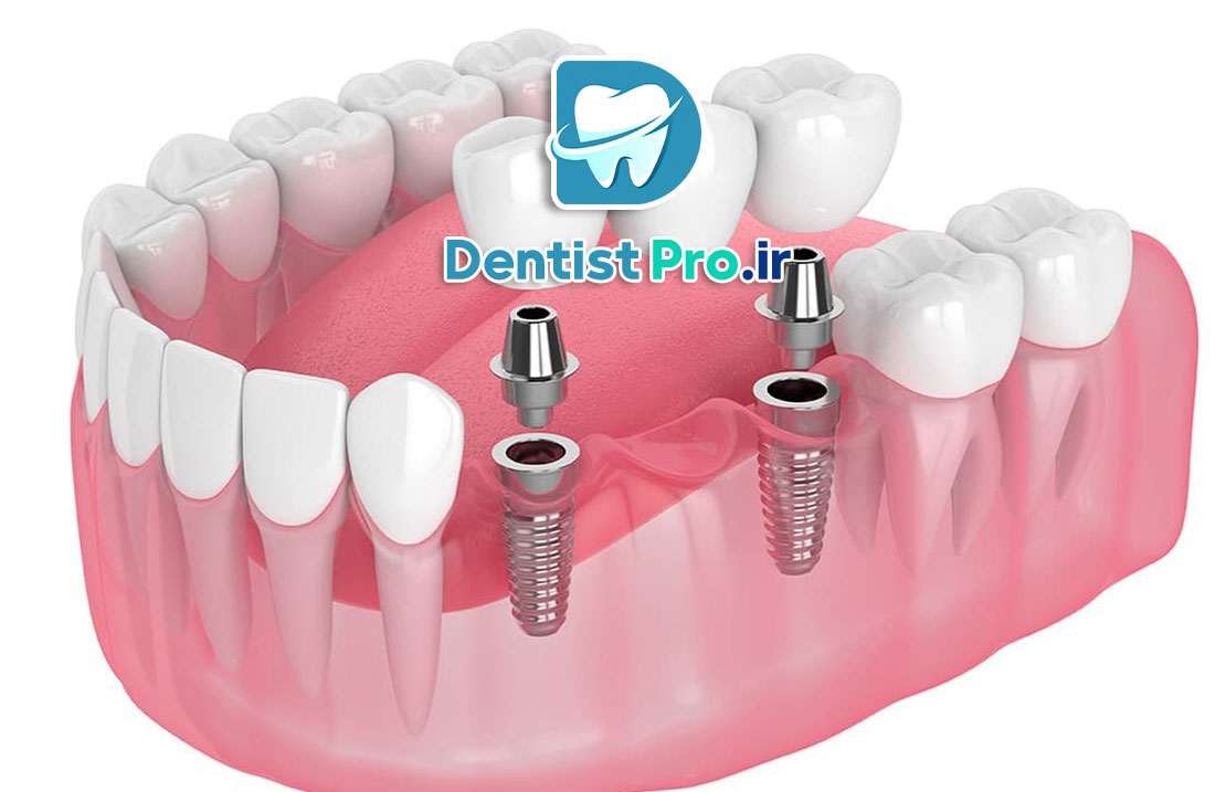 تفاوت ایمپلنت و بریج+بررسی 3 بعد مهم