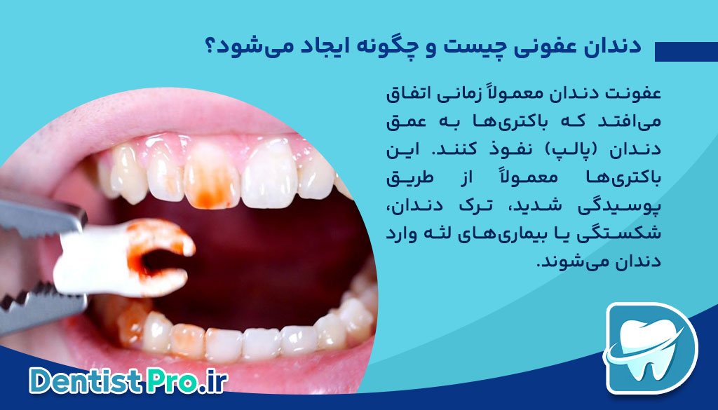 آیا باید دندان عفونی را بکشیم؟ هرآنچه باید درباره کشیدن دندان عفونی بدانید (از زبان یک متخصص)