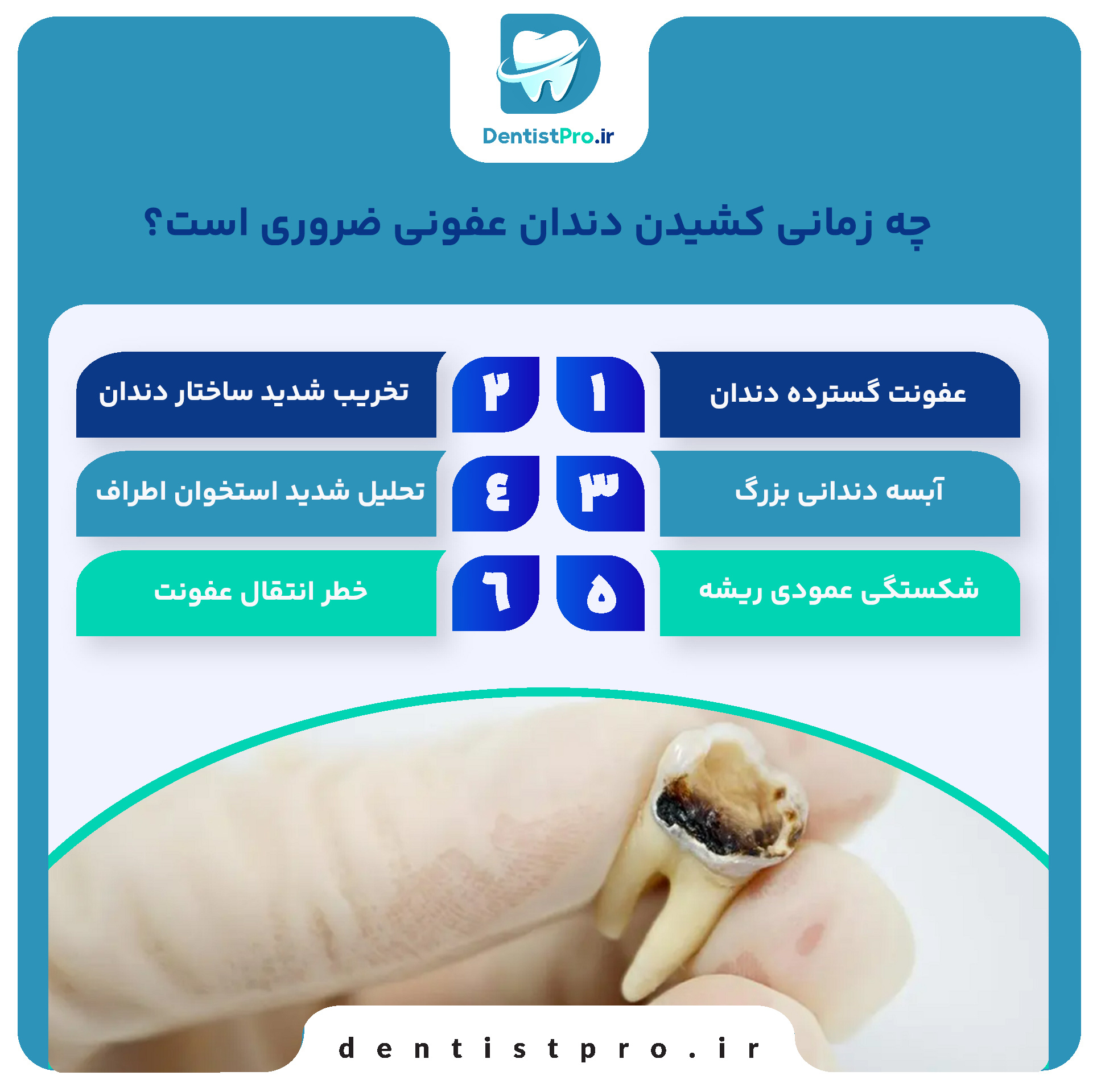 آیا باید دندان عفونی را بکشیم؟ هرآنچه باید درباره کشیدن دندان عفونی بدانید (از زبان یک متخصص)