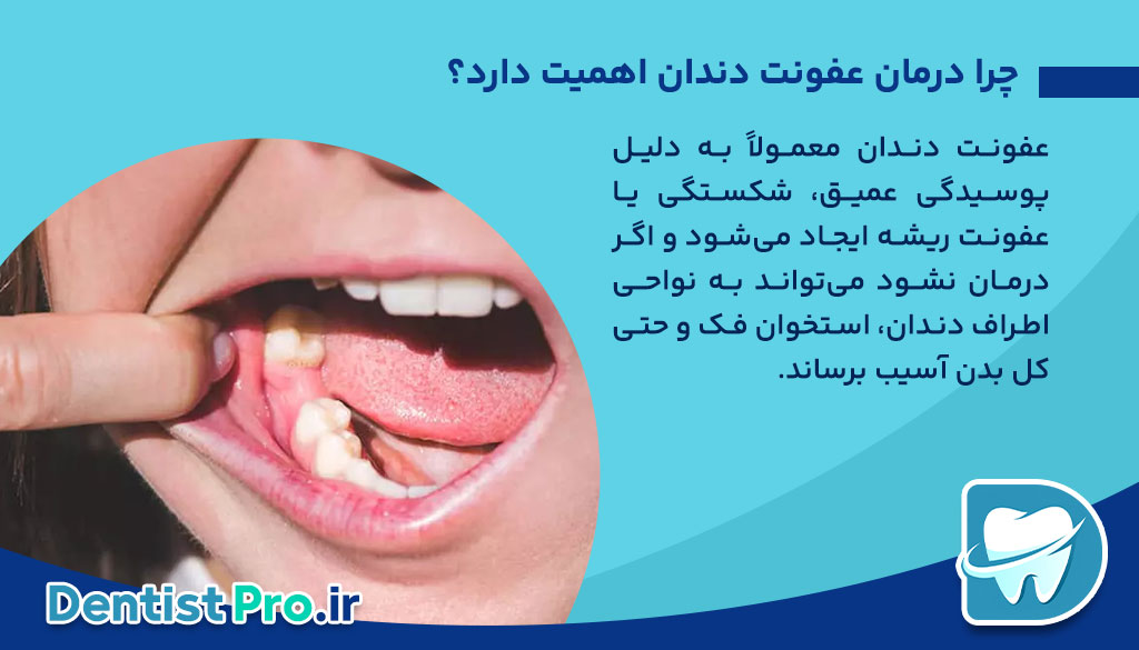 بهترین آنتی بیوتیک برای دندان عفونی+معرفی 5 آنتی بیوتیک 26 بهترین آنتی بیوتیک برای دندان عفونی+معرفی 5 آنتی بیوتیک