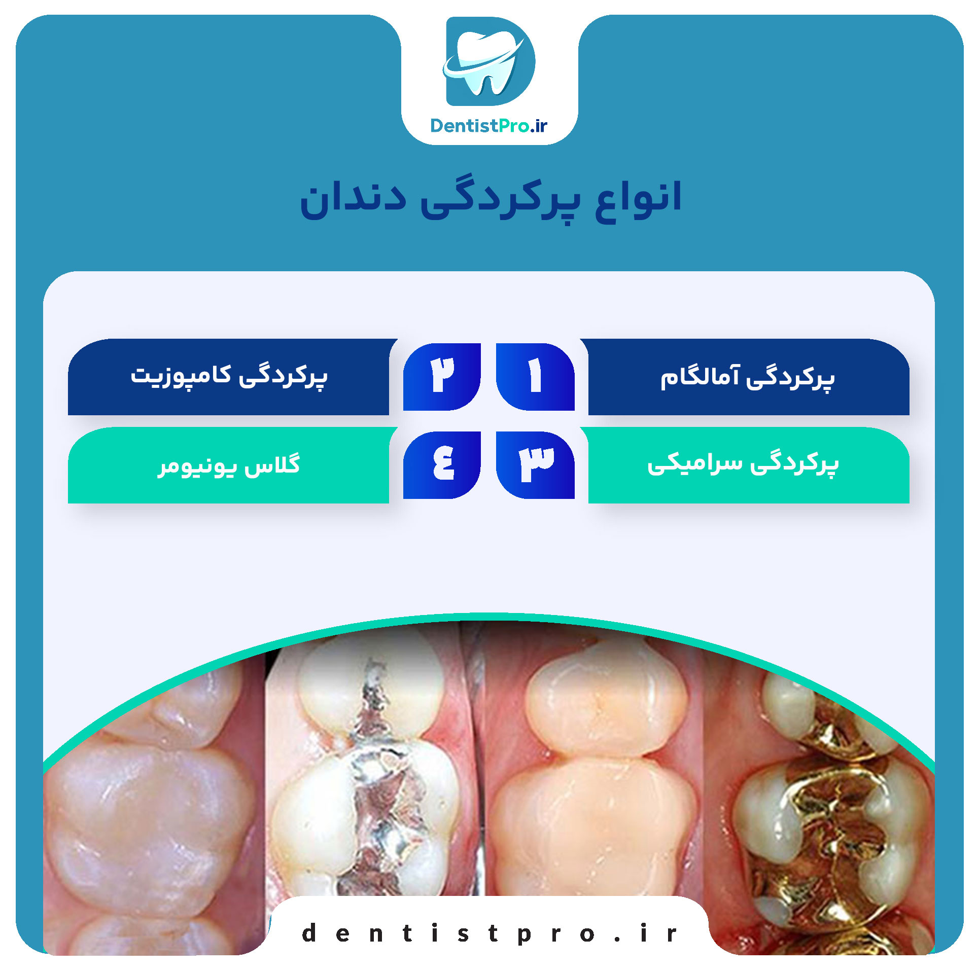 بهترین نوع پرکردگی برای دندان پوسیده چیست؟