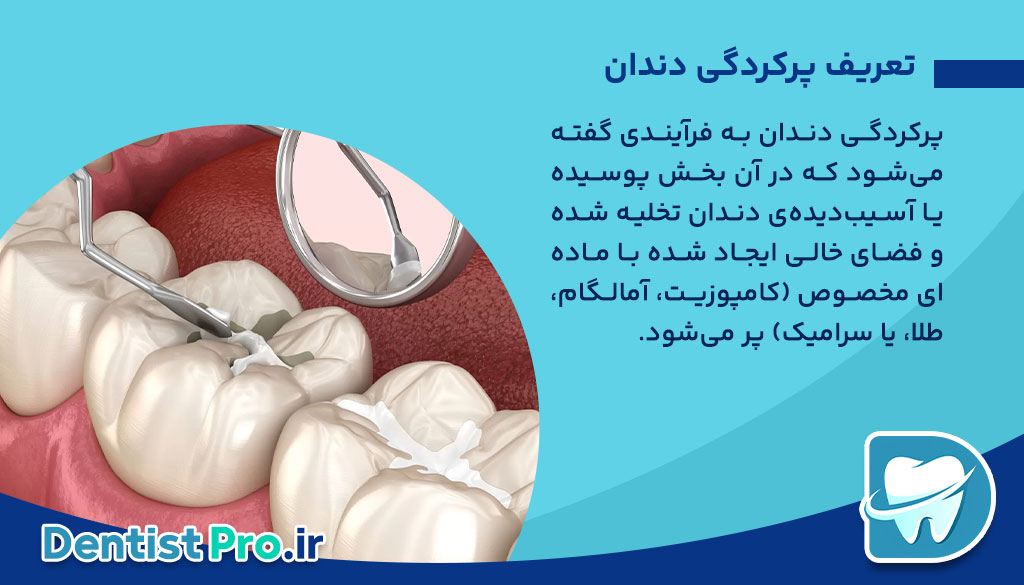 دوام پرکردگی دندان: بررسی جامع از زبان یک دندان‌پزشک