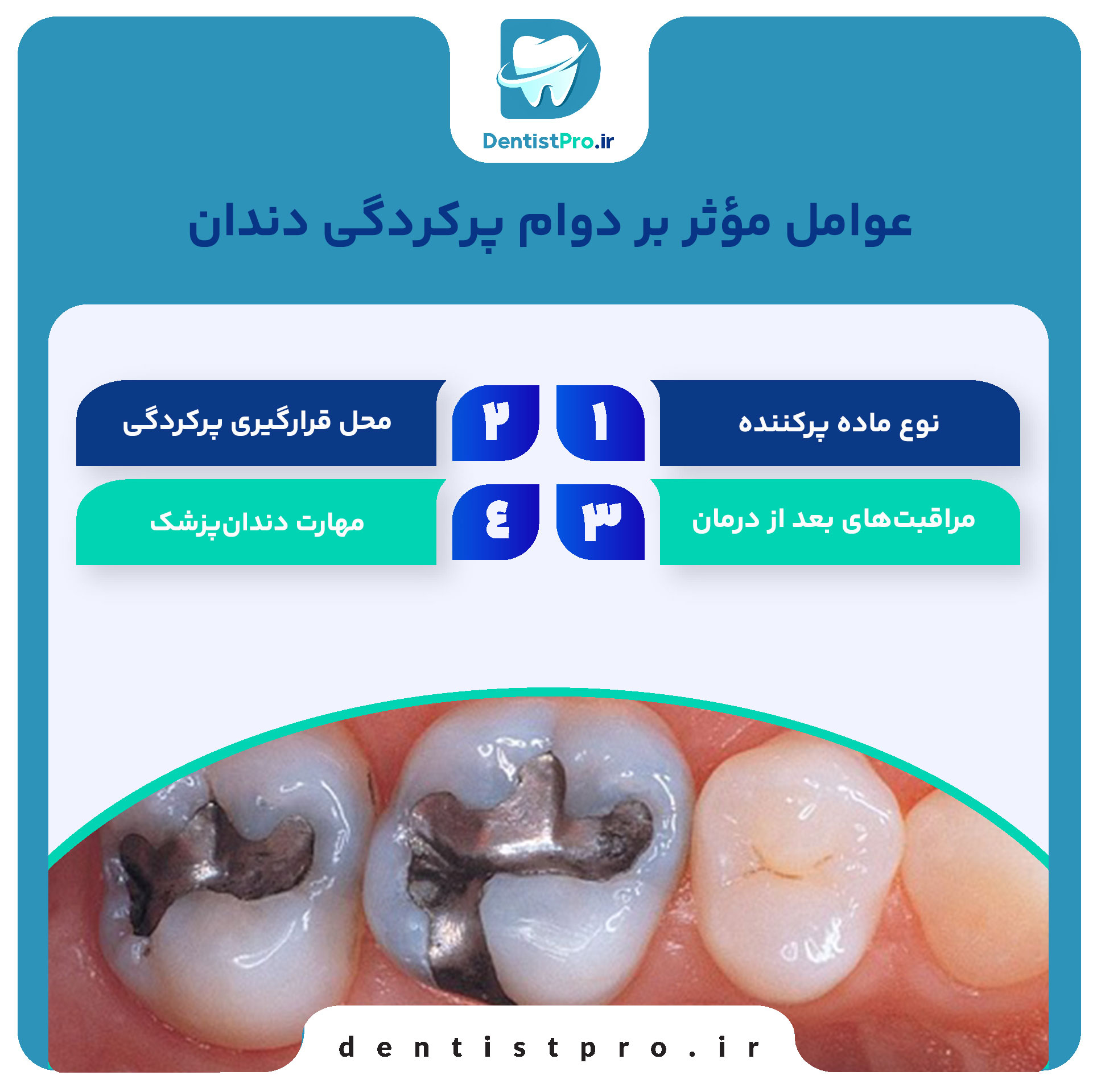 دوام پرکردگی دندان: بررسی جامع از زبان یک دندان‌پزشک