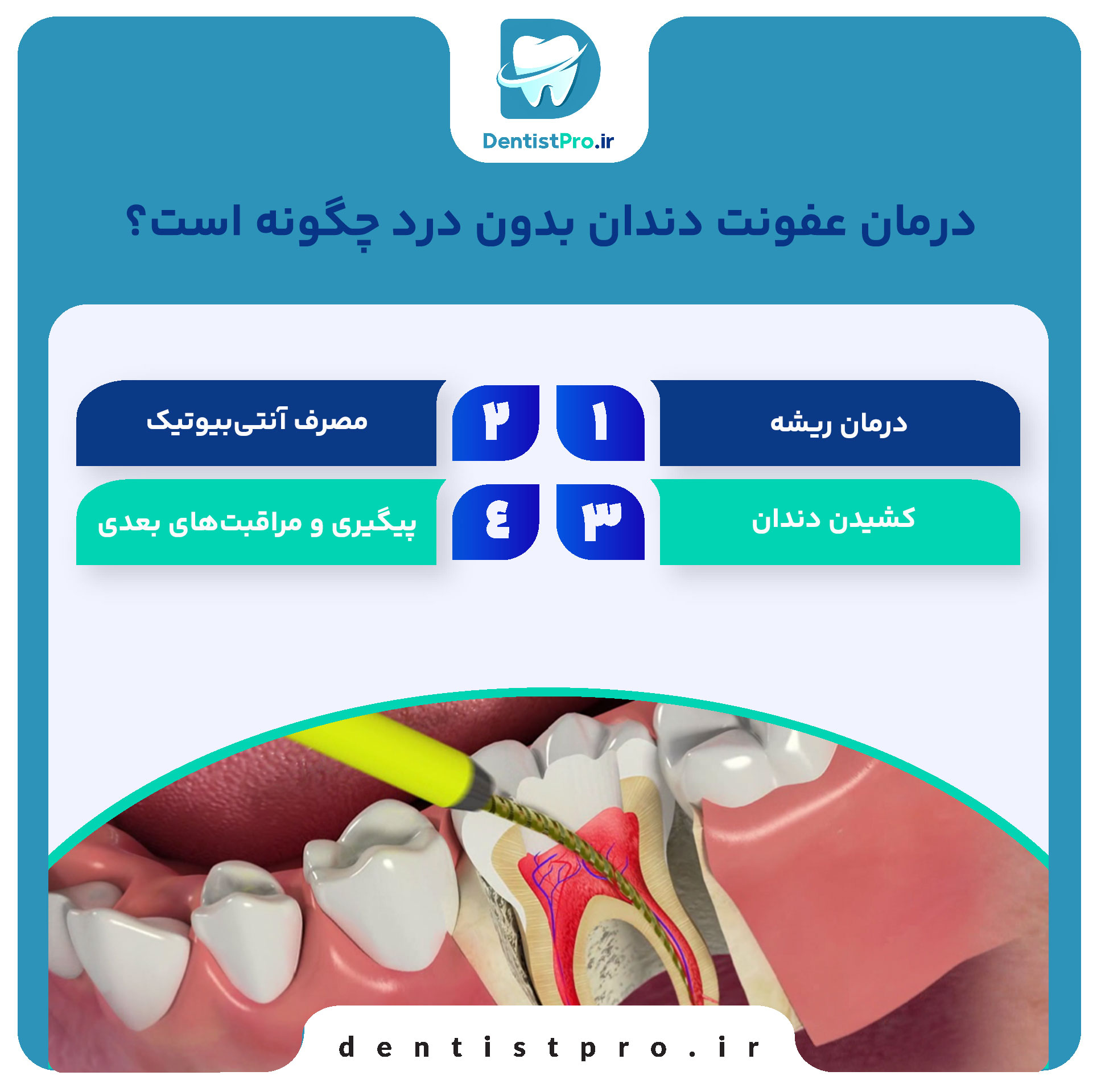 عفونت دندان بدون درد: تهدید خاموش سلامت دهان 28 عفونت دندان بدون درد: تهدید خاموش سلامت دهان