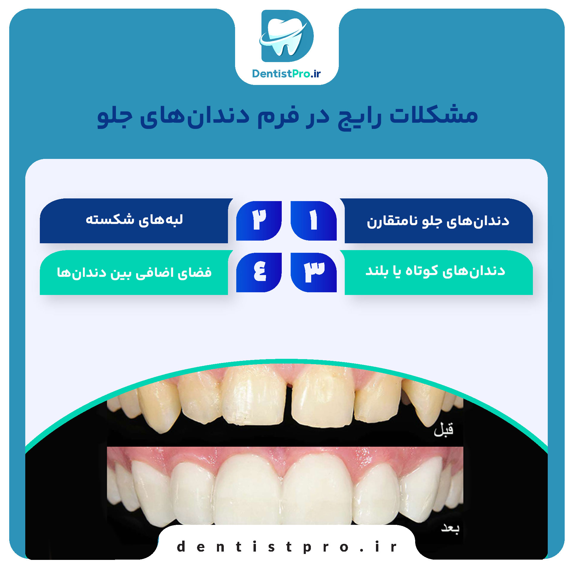 فرم دهی دندان های جلو؛ راهنمایی جامع از زبان یک متخصص دندانپزشک