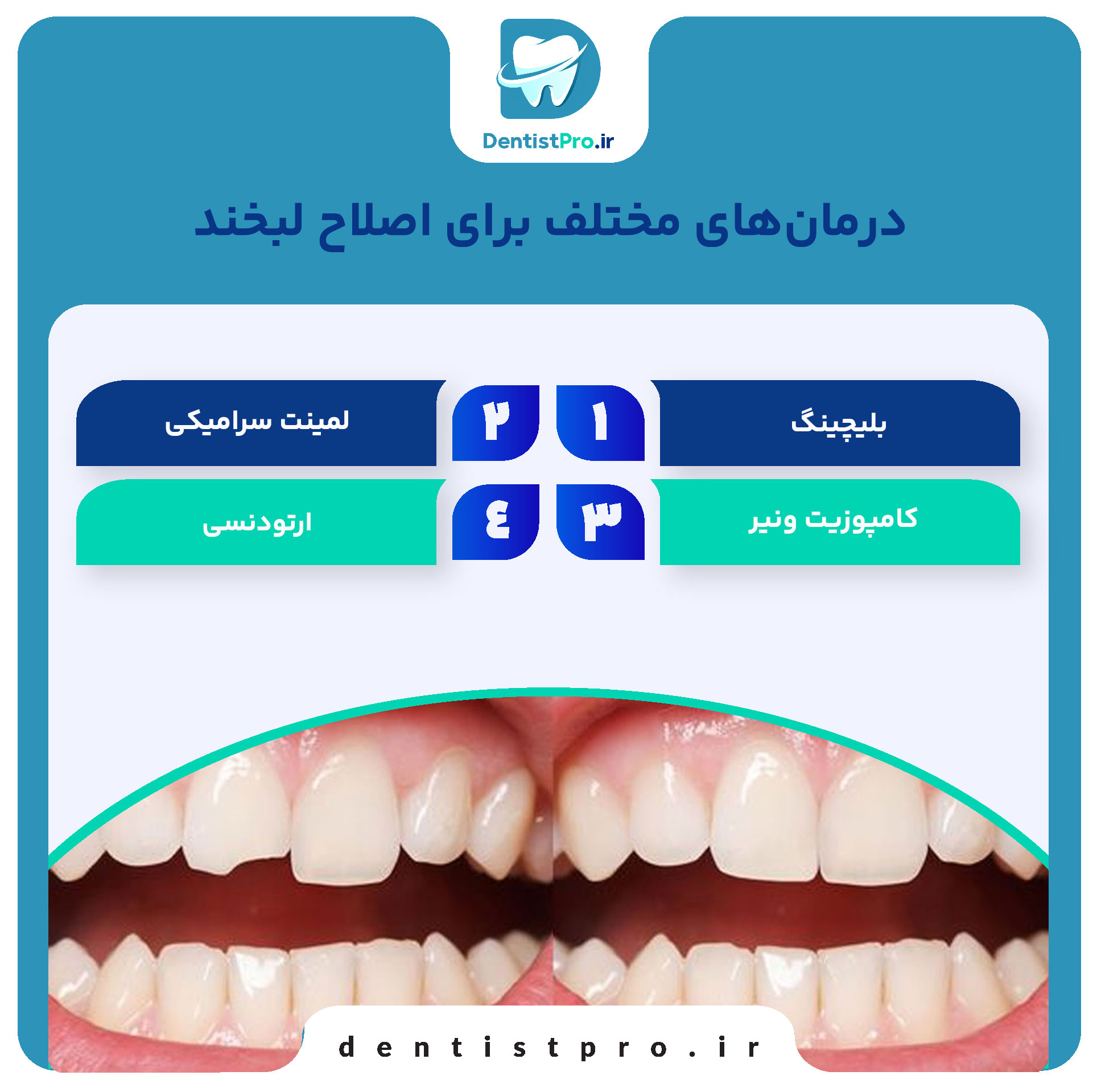قبل و بعد از اصلاح لبخند