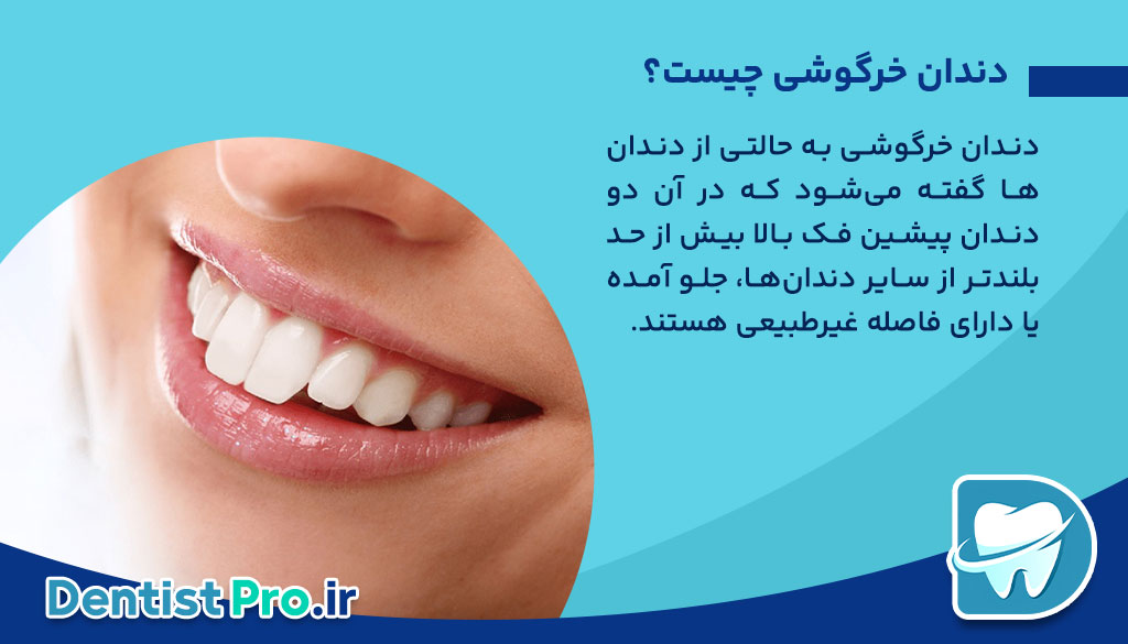 لمینت دندان خرگوشی چیست؟ روش اصلاح طرح لبخند و جذابتر شدن چهره 26 لمینت دندان خرگوشی چیست؟ روش اصلاح طرح لبخند و جذابتر شدن چهره