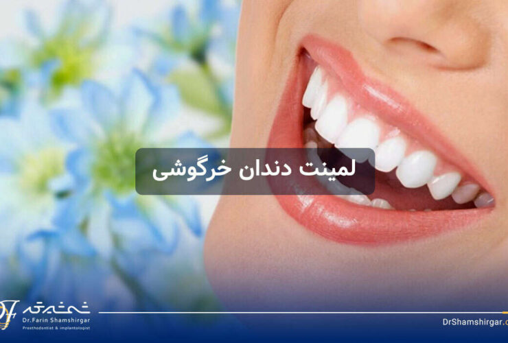 لمینت دندان خرگوشی چیست؟ روش اصلاح طرح لبخند و جذابتر شدن چهره 48 لمینت دندان خرگوشی
