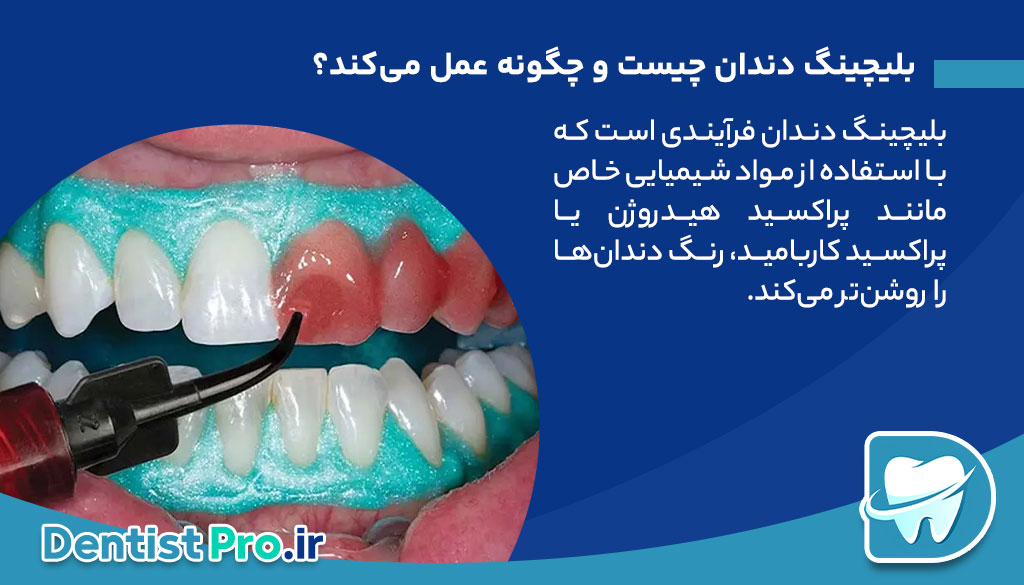 ماندگاری بلیچینگ دندان؛ راز داشتن لبخندی سفید و ماندگار 26 ماندگاری بلیچینگ دندان؛ راز داشتن لبخندی سفید و ماندگار