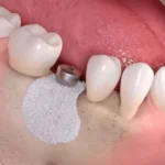 پودر استخوان دندانپزشکی؛ راهنمای جامع انتخاب، کاربرد و مراقبت