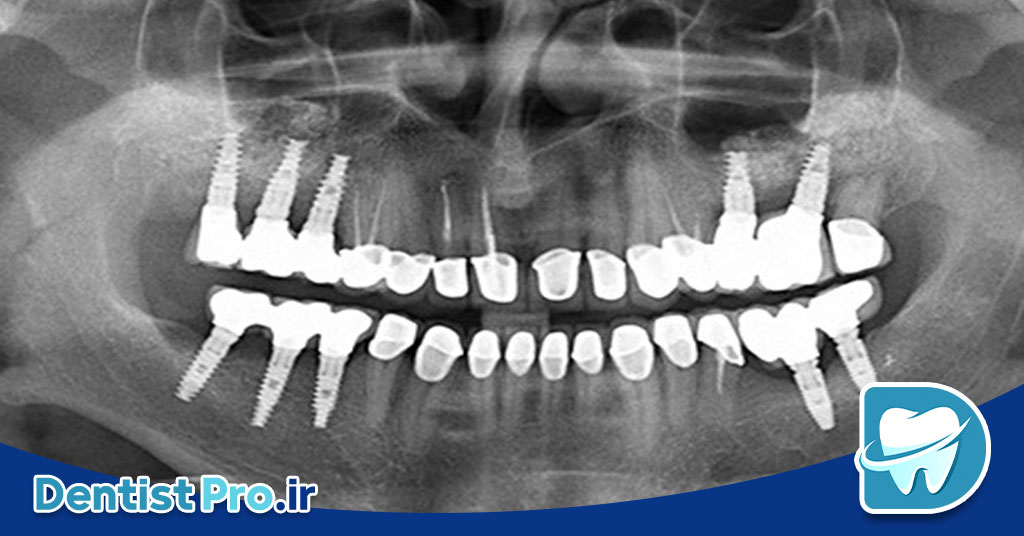 اندودنتیکس سه بعدی با تصویربرداری CBCT: تحولی در درمان ریشه دندان 26 اندودنتیکس سه بعدی با تصویربرداری CBCT: تحولی در درمان ریشه دندان