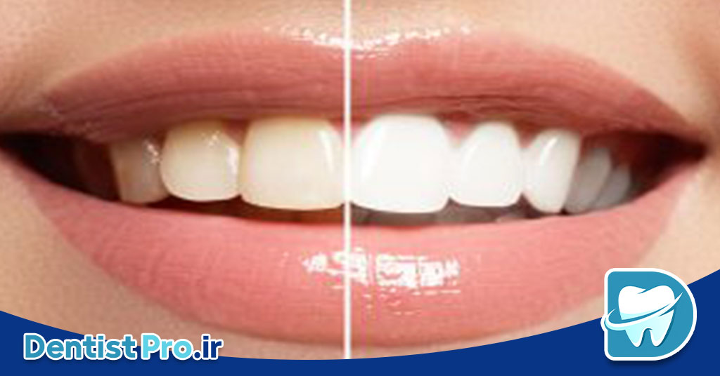 بلچینگ آکسیژن فعال شده: نوآوری در سفید کردن دندانها با تکنولوژی پیشرفته 26 بلچینگ آکسیژن فعال شده: نوآوری در سفید کردن دندانها با تکنولوژی پیشرفته