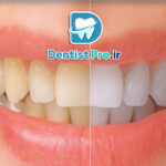 بلچینگ آکسیژن فعال شده: نوآوری در سفید کردن دندان‌ها با تکنولوژی پیشرفته