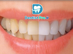 بلچینگ آکسیژن فعال شده: نوآوری در سفید کردن دندان‌ها با تکنولوژی پیشرفته