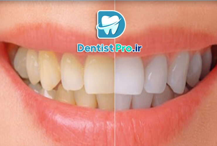 بلچینگ آکسیژن فعال شده: نوآوری در سفید کردن دندان‌ها با تکنولوژی پیشرفته