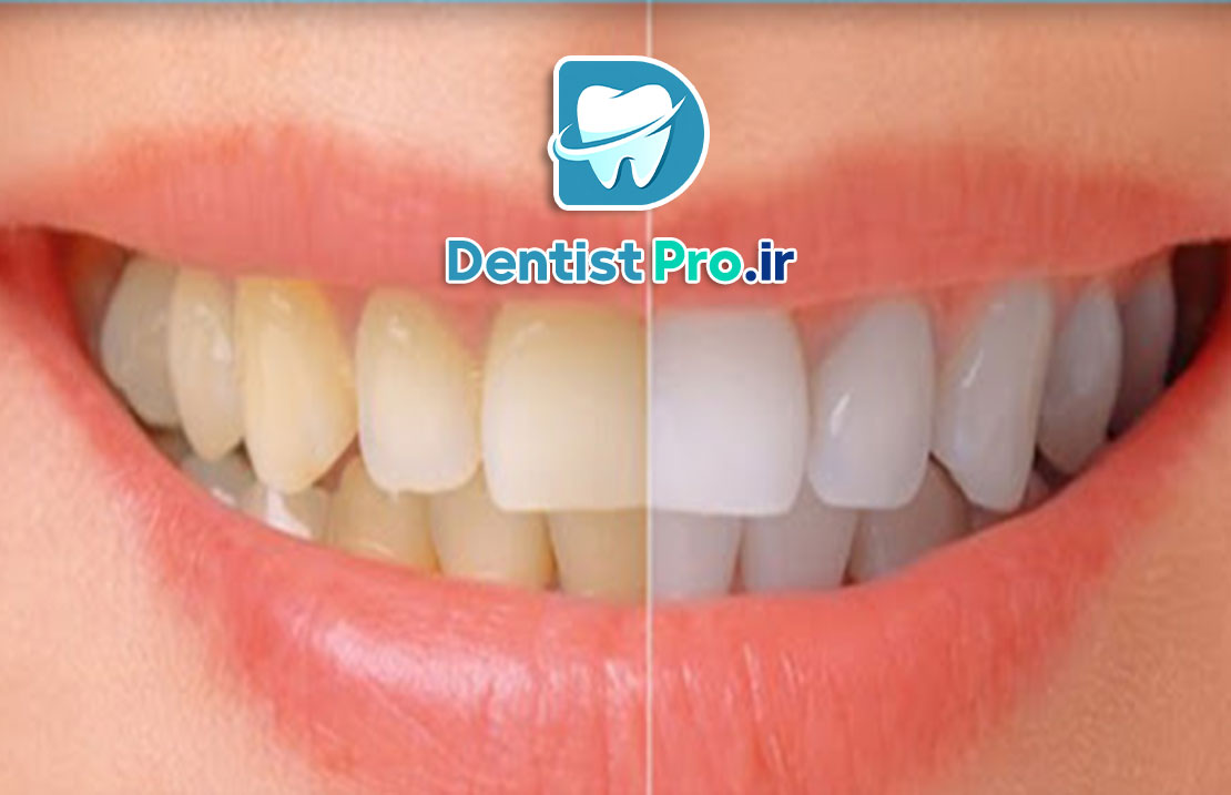 بلچینگ آکسیژن فعال شده: نوآوری در سفید کردن دندانها با تکنولوژی پیشرفته 25 بلچینگ آکسیژن فعال شده: نوآوری در سفید کردن دندانها با تکنولوژی پیشرفته