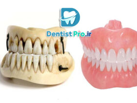 بازسازی آناتومیک دندان ها+ 5 مرحله که باید بدانید