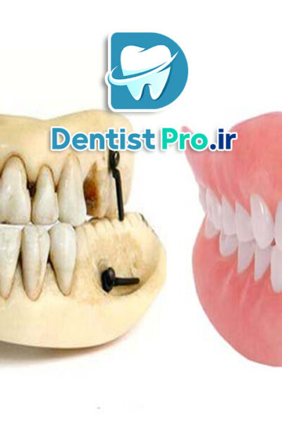 بازسازی آناتومیک دندان ها+ 5 مرحله که باید بدانید