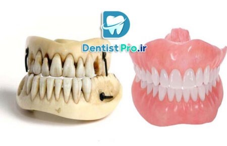 بازسازی آناتومیک دندان ها+ 5 مرحله که باید بدانید