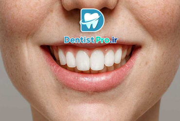 بازسازی آناتومیک مینای دندان: هنر حفظ و بازگردانی ساختار طبیعی دندان