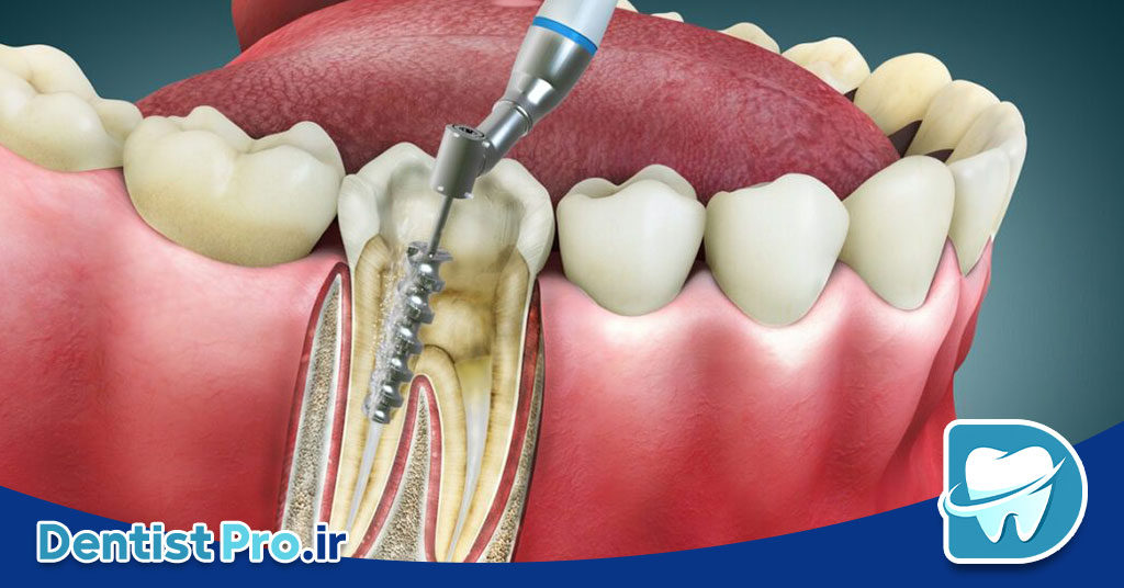 درمان پوسیدگی با رزین های بایواکتیو مقاوم به اسید: راهکاری نوین و مؤثر در دندانپزشکی 26 درمان پوسیدگی با رزین های بایواکتیو مقاوم به اسید: راهکاری نوین و مؤثر در دندانپزشکی