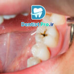 درمان پوسیدگی با رزین های بایواکتیو مقاوم به اسید: راهکاری نوین و مؤثر در دندانپزشکی