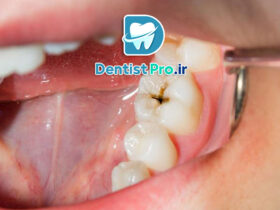 درمان پوسیدگی با رزین های بایواکتیو مقاوم به اسید: راهکاری نوین و مؤثر در دندانپزشکی