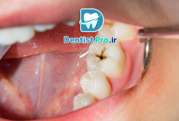 درمان پوسیدگی با رزین های بایواکتیو مقاوم به اسید: راهکاری نوین و مؤثر در دندانپزشکی