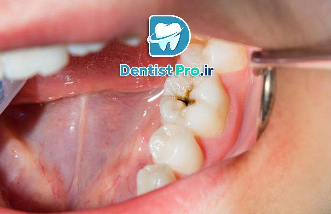 درمان پوسیدگی با رزین های بایواکتیو مقاوم به اسید: راهکاری نوین و مؤثر در دندانپزشکی 25 درمان پوسیدگی با رزین های بایواکتیو مقاوم به اسید: راهکاری نوین و مؤثر در دندانپزشکی