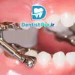 ارتودنسی فانکشنال کودکان چیست؟