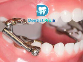 ارتودنسی فانکشنال کودکان چیست؟