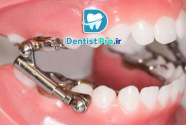 ارتودنسی فانکشنال کودکان چیست؟