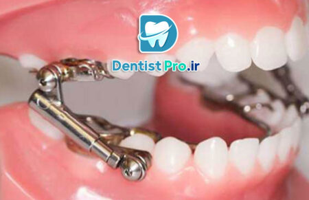 ارتودنسی فانکشنال کودکان چیست؟