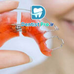 بریس های متحرک ارتودنسی کودکان: راهکاری موثر و انعطاف‌پذیر در اصلاح مشکلات دندانی