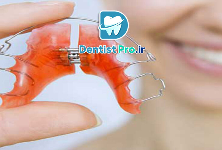 بریس های متحرک ارتودنسی کودکان: راهکاری موثر و انعطاف‌پذیر در اصلاح مشکلات دندانی
