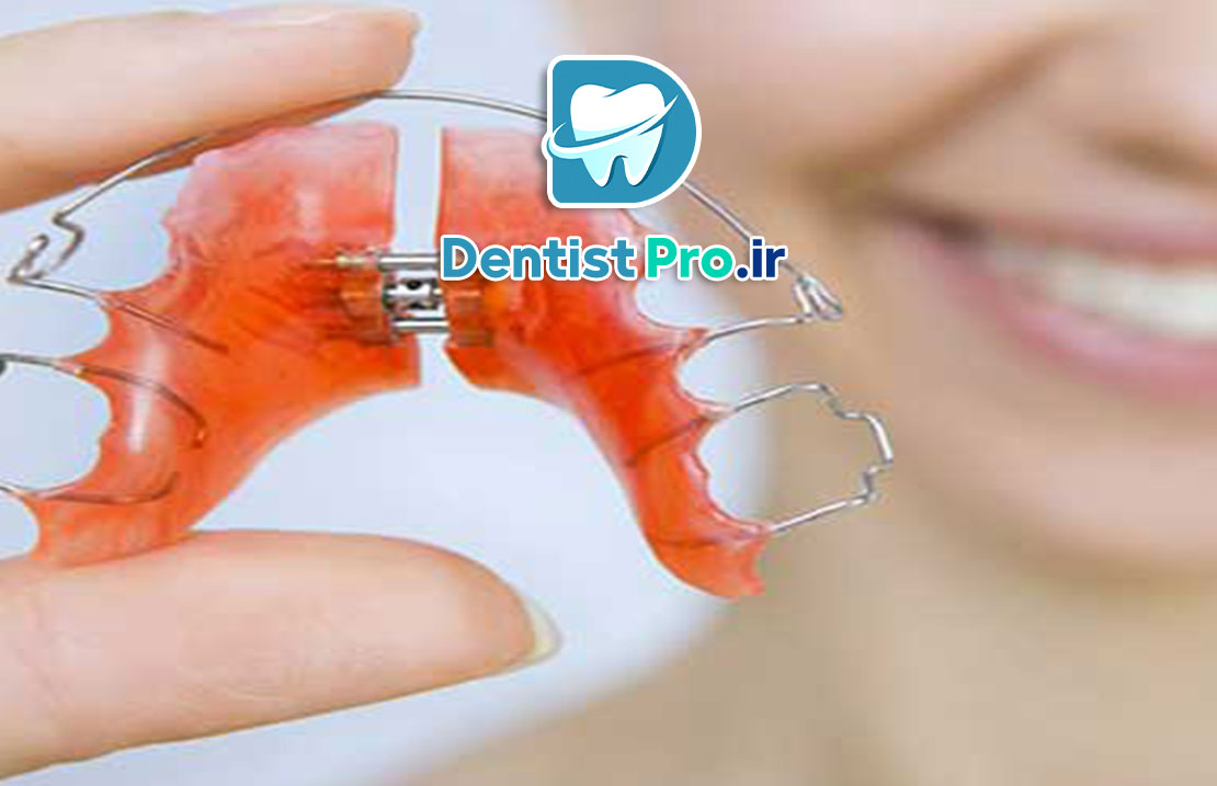بریس های متحرک ارتودنسی کودکان: راهکاری موثر و انعطاف‌پذیر در اصلاح مشکلات دندانی