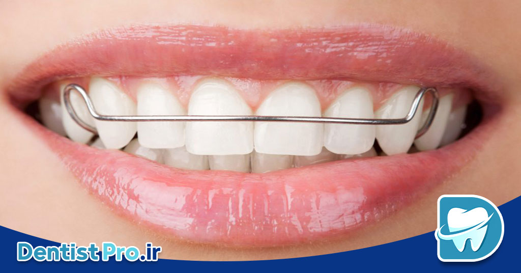 بریس های متحرک ارتودنسی کودکان: راهکاری موثر و انعطاف‌پذیر در اصلاح مشکلات دندانی