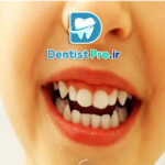 ونیر کامپوزیت مخصوص کودکان: راهکاری موثر برای زیبایی و سلامت دندان‌های کودک