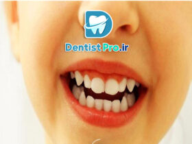 ونیر کامپوزیت مخصوص کودکان: راهکاری موثر برای زیبایی و سلامت دندان‌های کودک