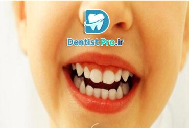 ونیر کامپوزیت مخصوص کودکان: راهکاری موثر برای زیبایی و سلامت دندان‌های کودک