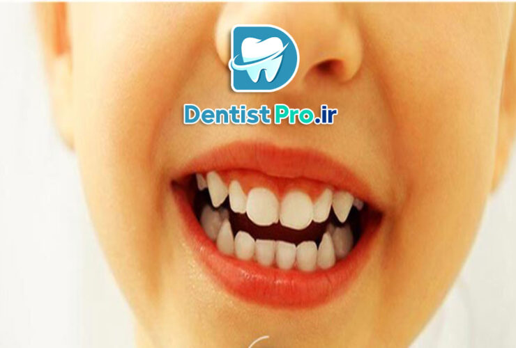 ونیر کامپوزیت مخصوص کودکان: راهکاری موثر برای زیبایی و سلامت دندانهای کودک 27 ونیر کامپوزیت مخصوص کودکان: راهکاری موثر برای زیبایی و سلامت دندانهای کودک