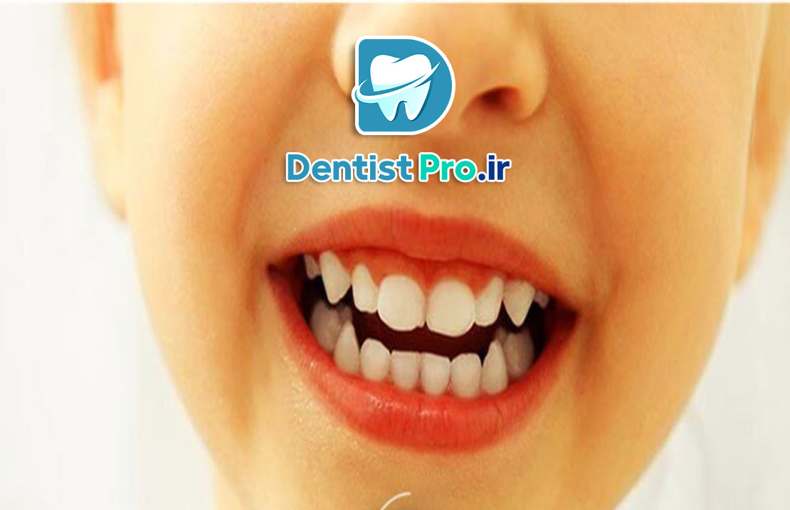 ونیر کامپوزیت مخصوص کودکان: راهکاری موثر برای زیبایی و سلامت دندانهای کودک 25 ونیر کامپوزیت مخصوص کودکان: راهکاری موثر برای زیبایی و سلامت دندانهای کودک