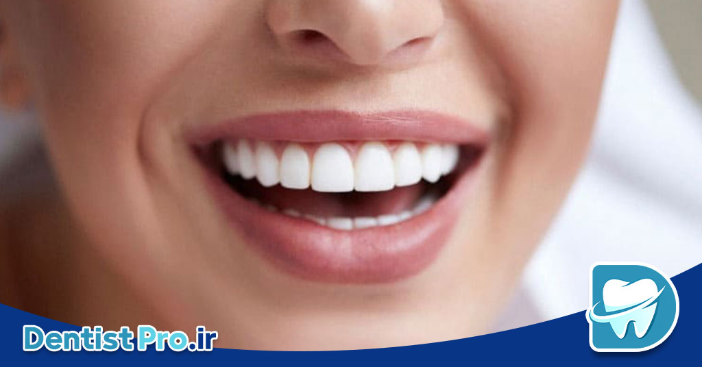 اصلاح عیوب لبخند با ترکیب ارتودنسی: راهنمای جامع زیبایی و سلامت دندان 26 اصلاح عیوب لبخند با ترکیب ارتودنسی: راهنمای جامع زیبایی و سلامت دندان