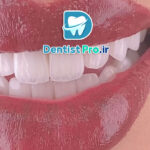 ترمیم زیبایی دندان با کامپوزیت لایه ای: هنر و علم زیبایی دندانپزشکی